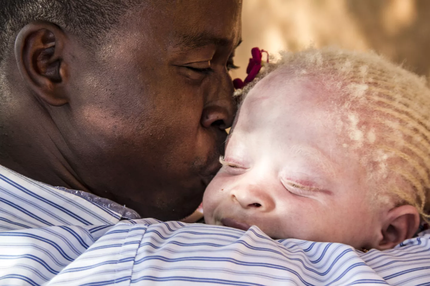 Father kisses hid albino child