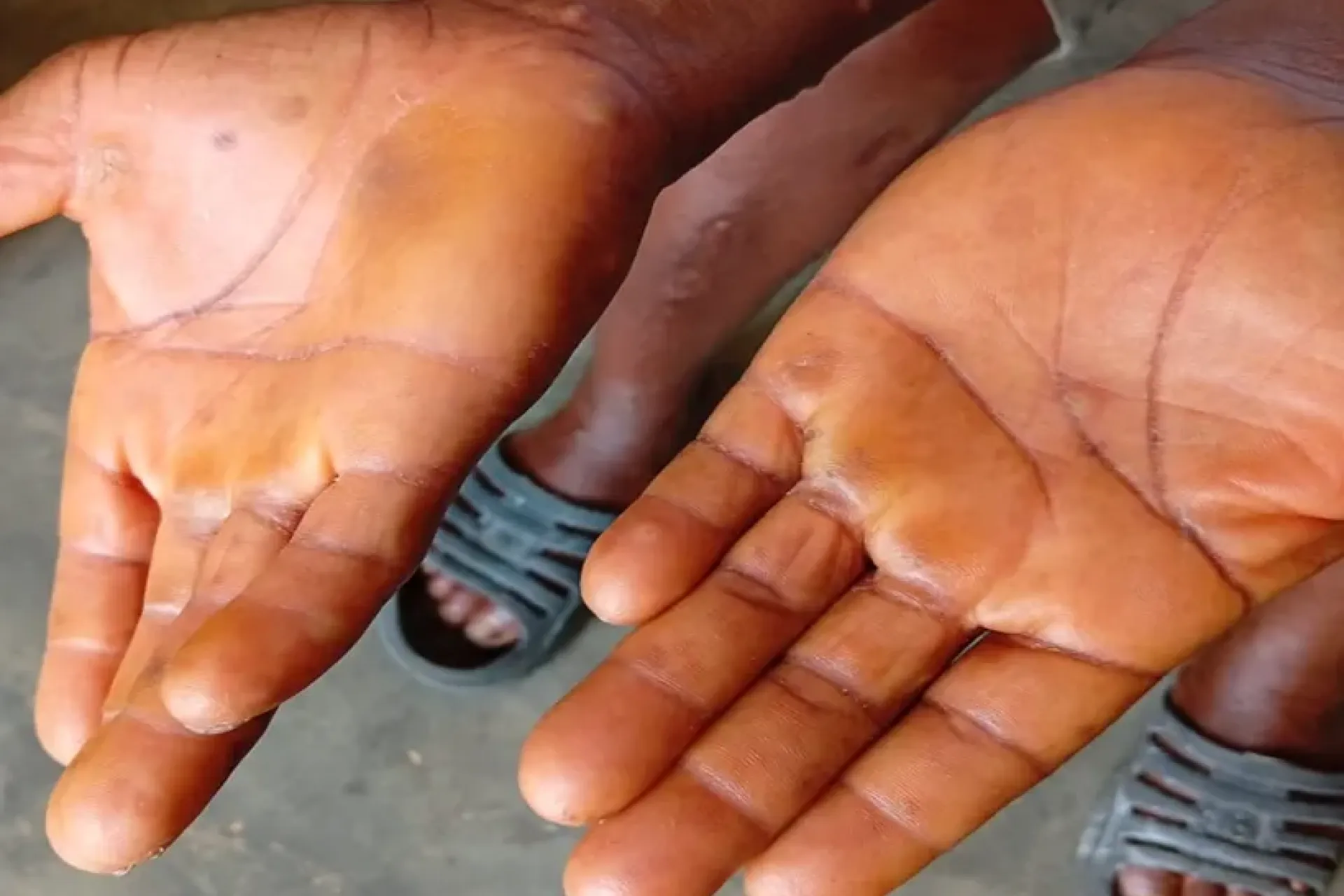 survivante Mpox