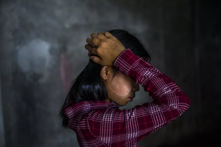 A girl, standing in the dark with her hands on her head. She bears the lasting scars of a tragic landmine explosion. The incident, which claimed the life of her brother, occurred when he unknowingly picked up a landmine, mistaking it for a toy, while playing just outside their home.