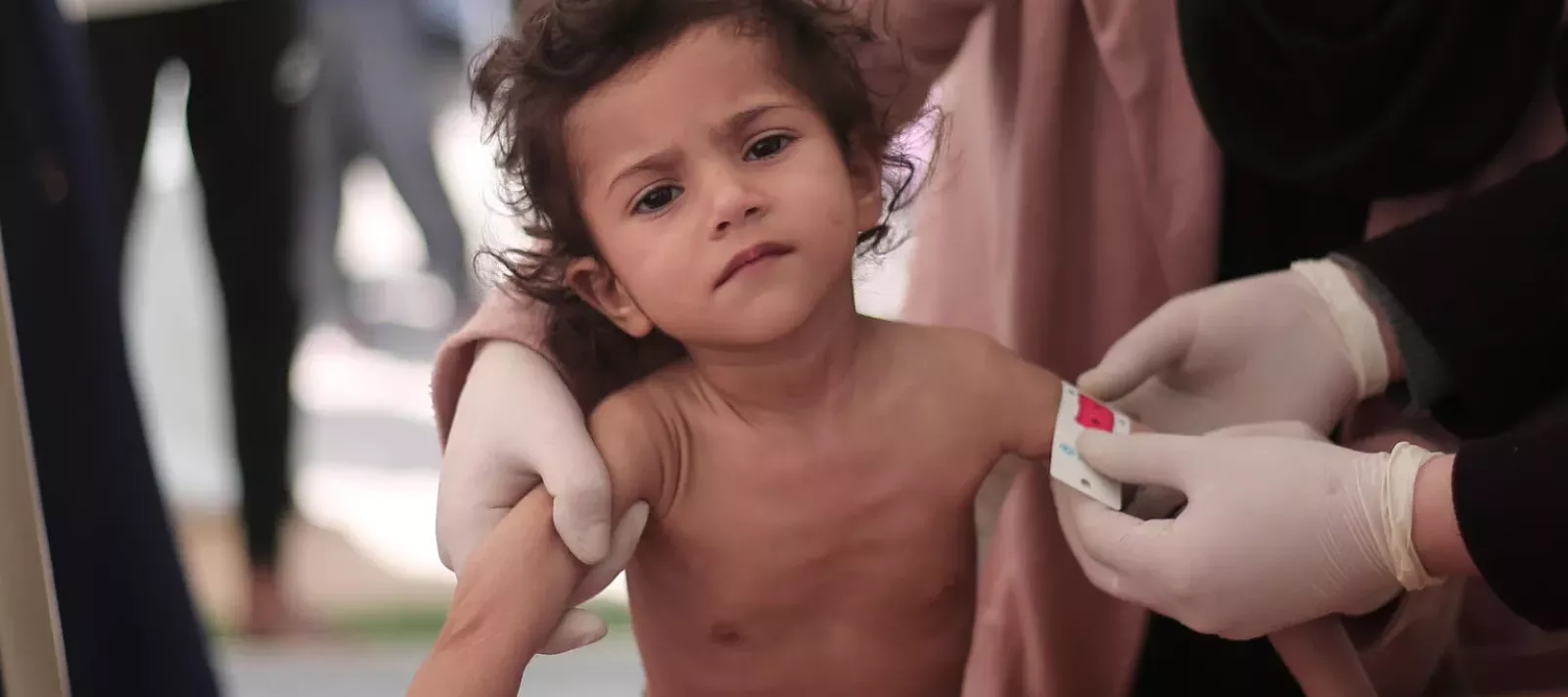 Leen, 2-year-old, is getting her middle-upper-arm-circumference (MUAC) measured, her MUAC reads less than 10, indicating sever acute malnutrition and drastic weight loss and muscle atrophy.