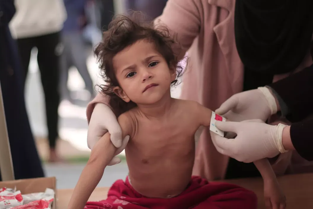 Leen, 2-year-old, is getting her middle-upper-arm-circumference (MUAC) measured, her MUAC reads less than 10, indicating sever acute malnutrition and drastic weight loss and muscle atrophy.