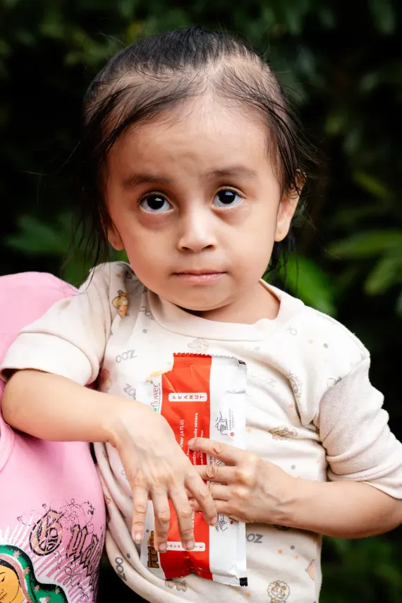 Fernanda de 2 a&ntilde;os con tratamiento por desnutricion aguda