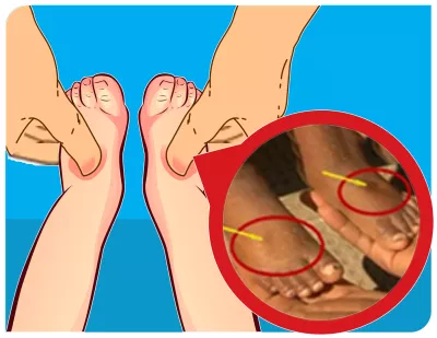 Bengkak di kedua punggung kaki
