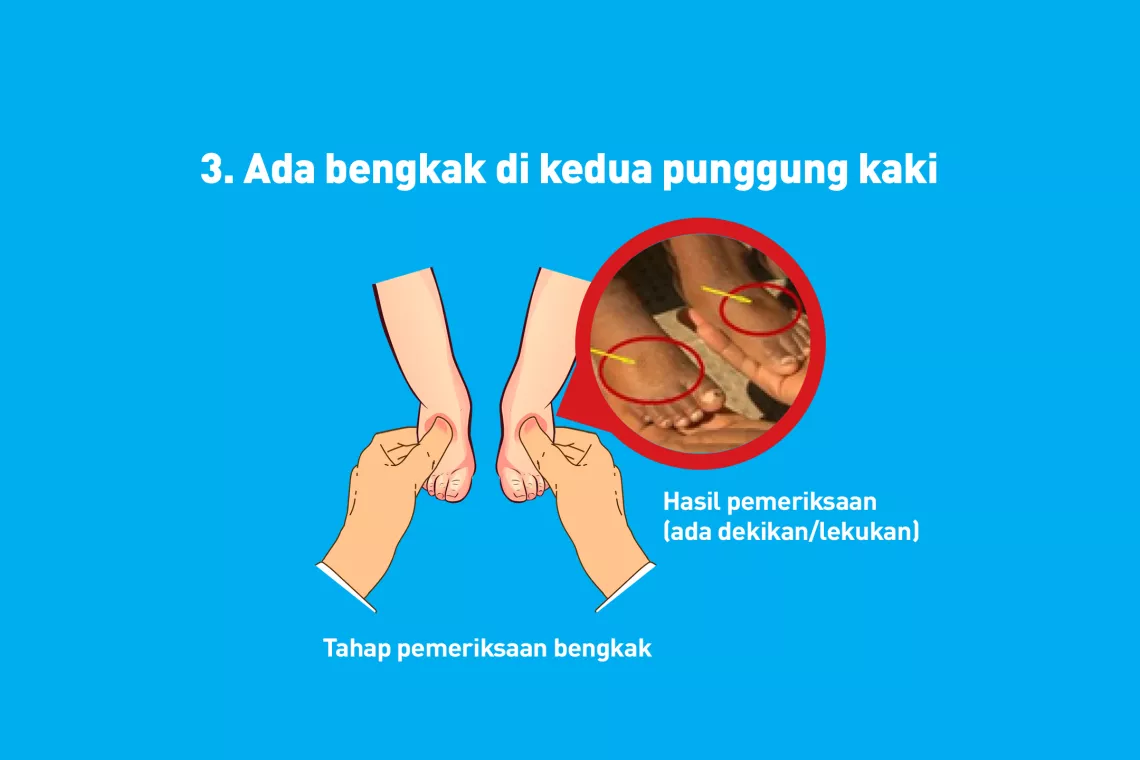 Ada bengkak di kedua punggung kaki