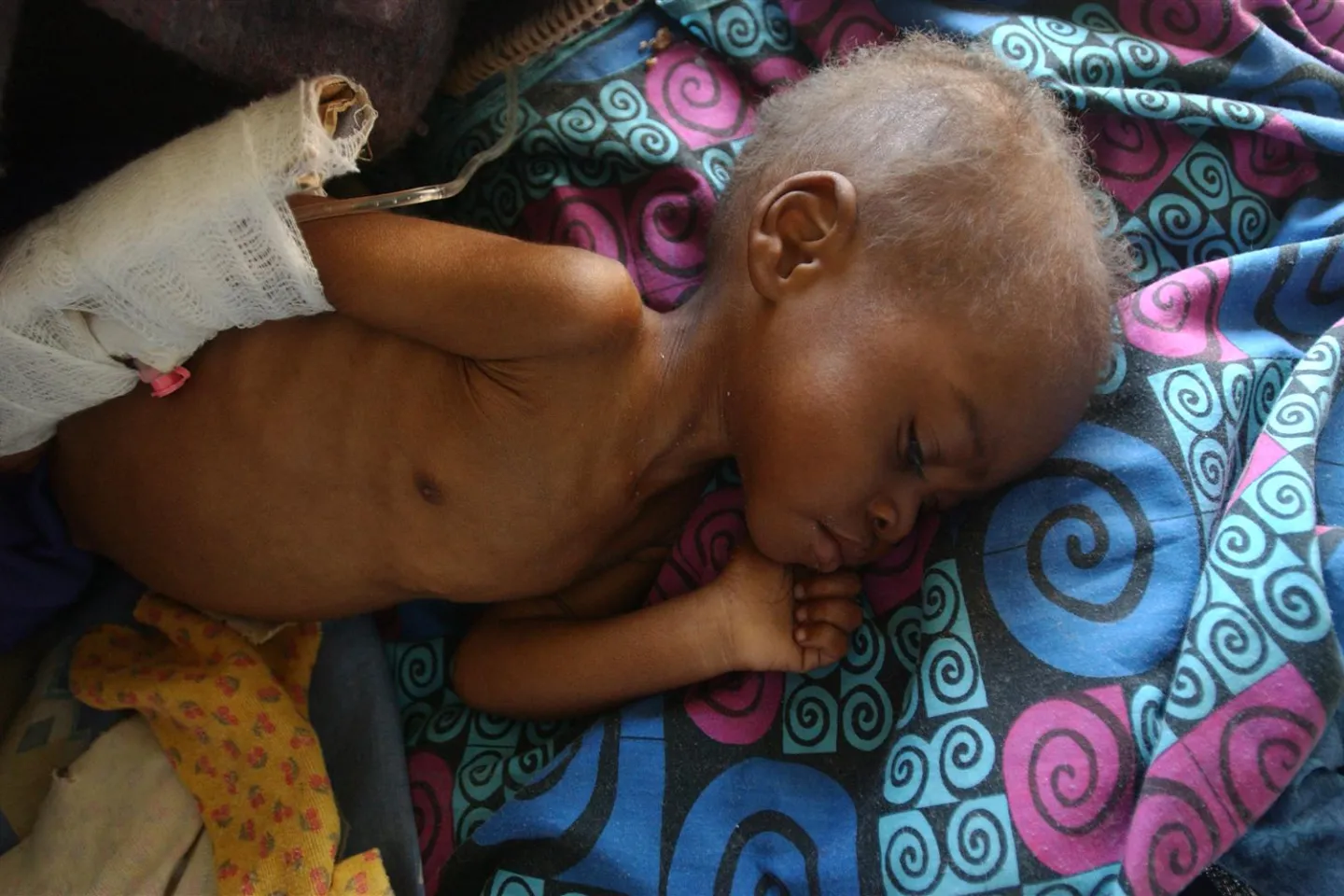 Severely malnourished due to the ongoing food shortages in the country, David also has pneumonia and other illnesses linked to malnutrition.