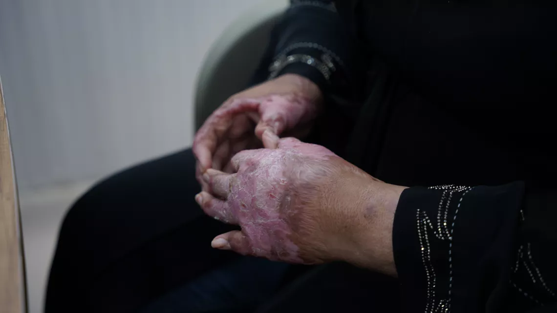 Sarah hands which she burnt herself and remain untreated fully.
