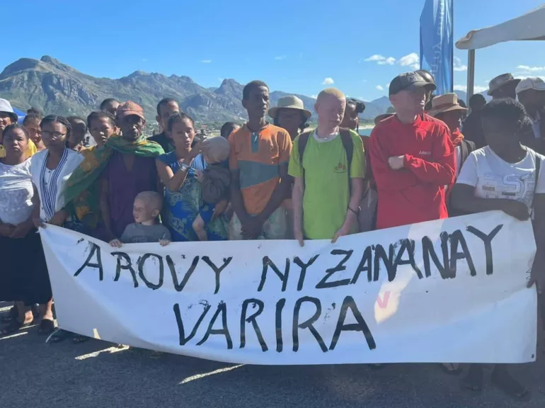 Prot&eacute;geons les enfants atteints d'albinisme