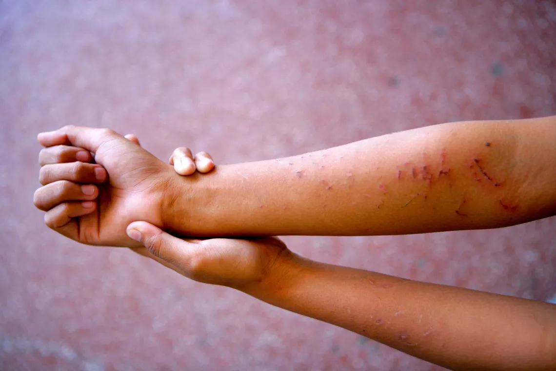 child's injured hands