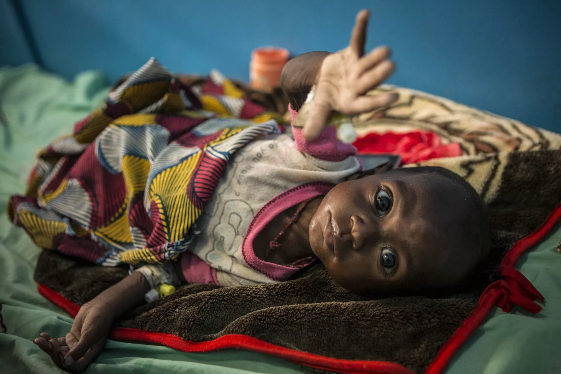 A child suffering from severe acute malnutrition