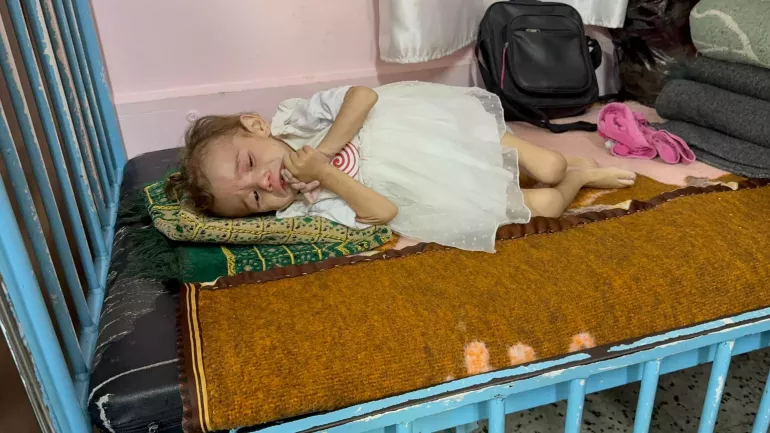 On 5 June 2025, Mariam, 2 years old, lies on a bed at Nasser Hospital in Khan Younis in the Gaza Strip. Mariam suffers from acute malnutrition. She weighs just 5 kilograms, whereas the average weight for a two-year-old should be around 11 kilograms. Her mother explains that Mariam was in good health when she was born, but she began losing weight a few months ago. Now, she is often too weak to eat and is visibly exhausted. She urgently needs nutritional support and appropriate medical treatment.