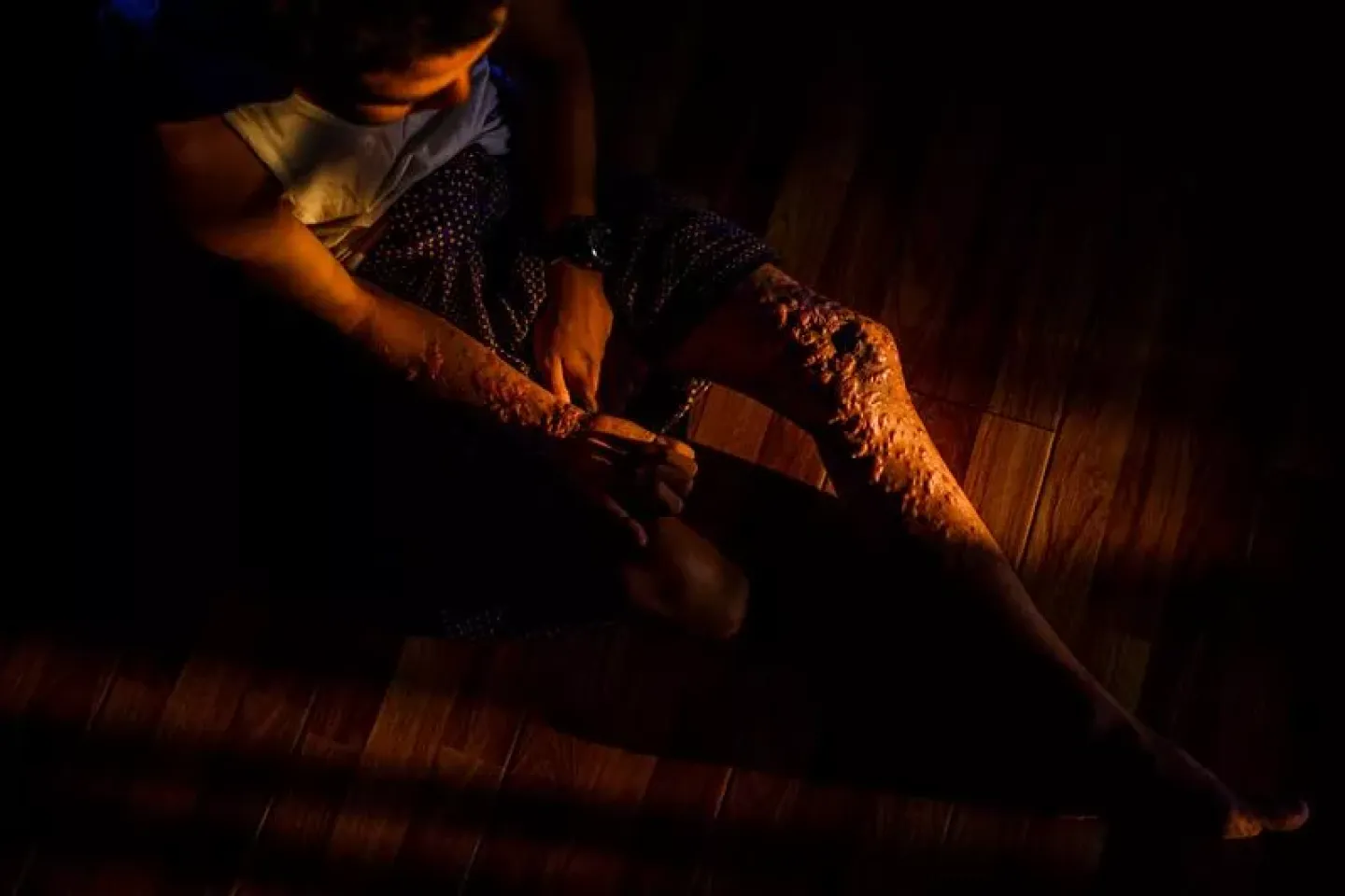 A child showing his wounds from landmine. 