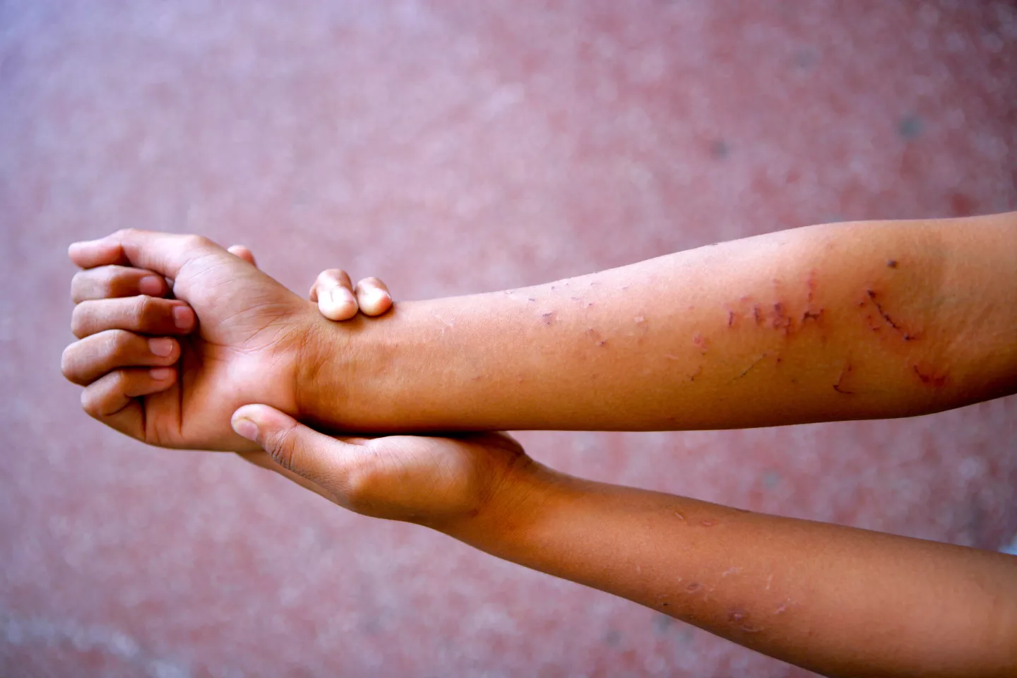 A child's bruised arms