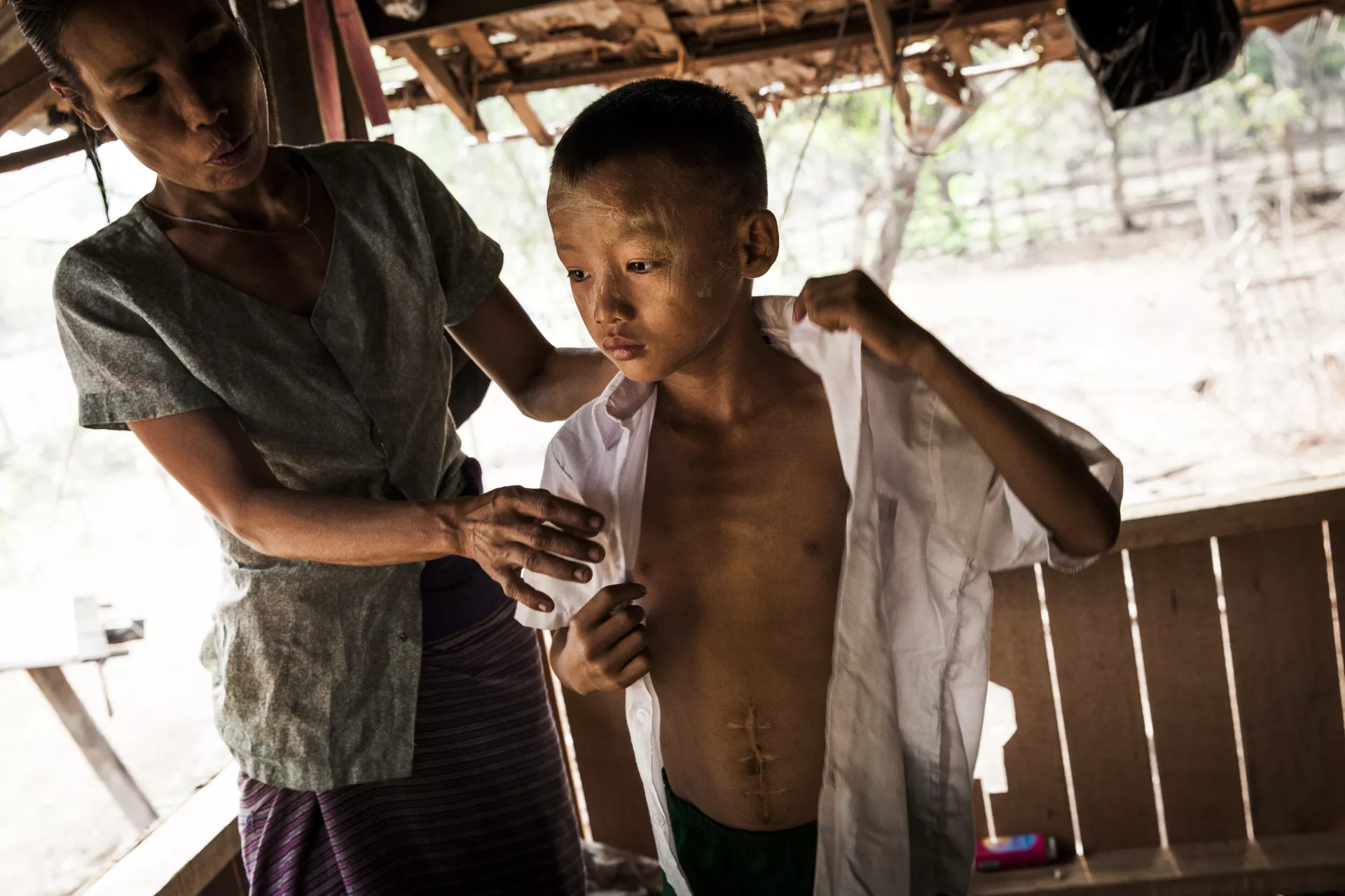 A ten-year-old boy in Myanmar shows a large scar from injuries he sustained while playing with an explosive remnant of war in 2017.