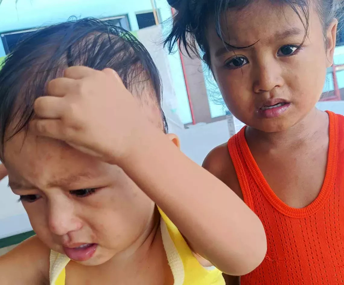 Two young children with visible marks of measles on their forehead and skin