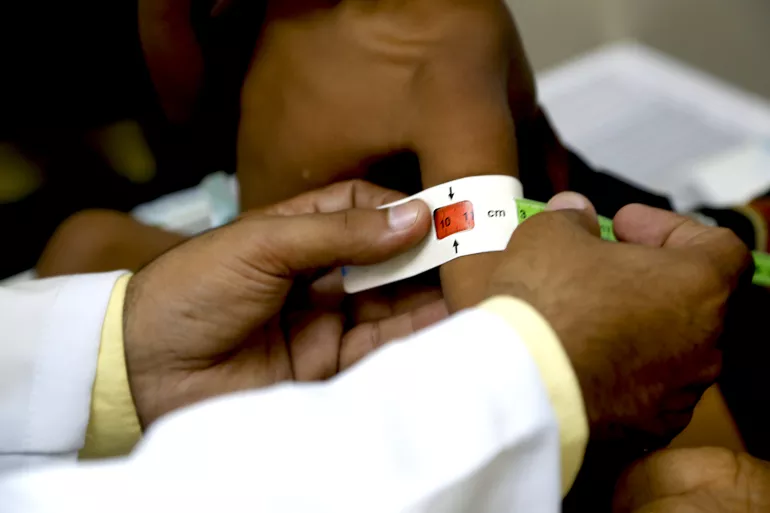Yemen. A girl suffering from severe malnutrition.