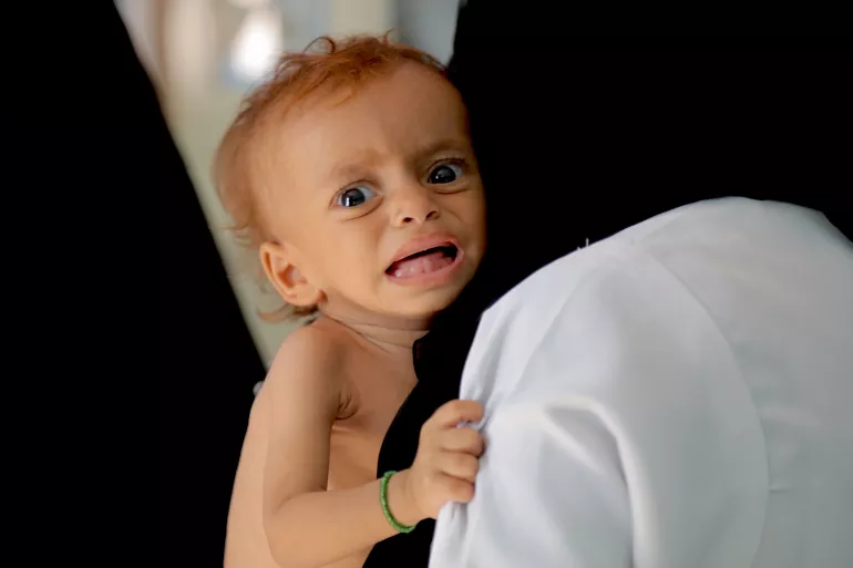 Yemen. A child recovers from malnutrition in Yemen.