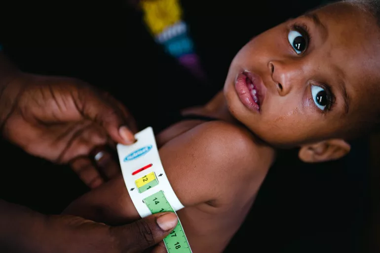 Un niño es revisado por malnutrición
