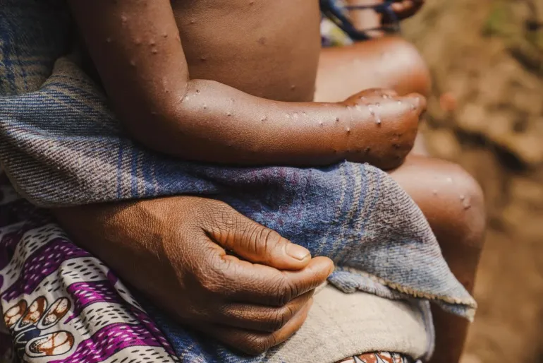 A mother holds her child who has mpox