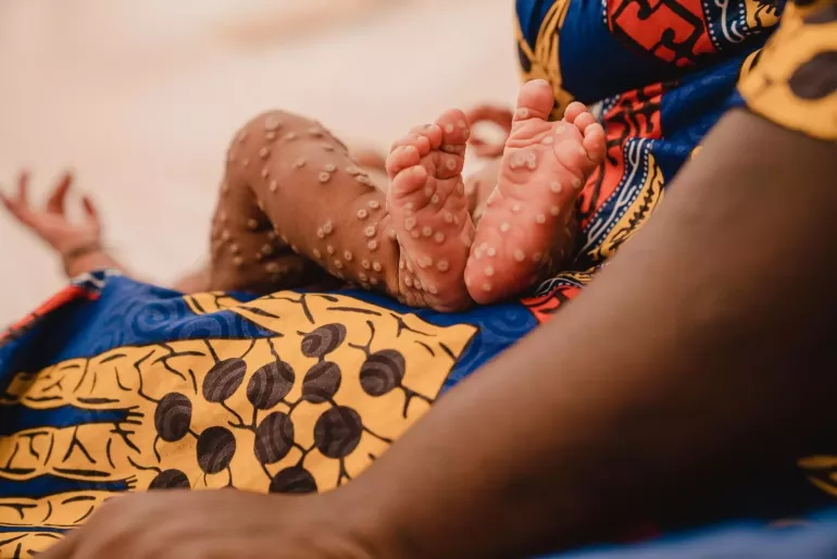 A young baby's feet and legs are covered with an mpox skin rash while resting on their mother's lap.